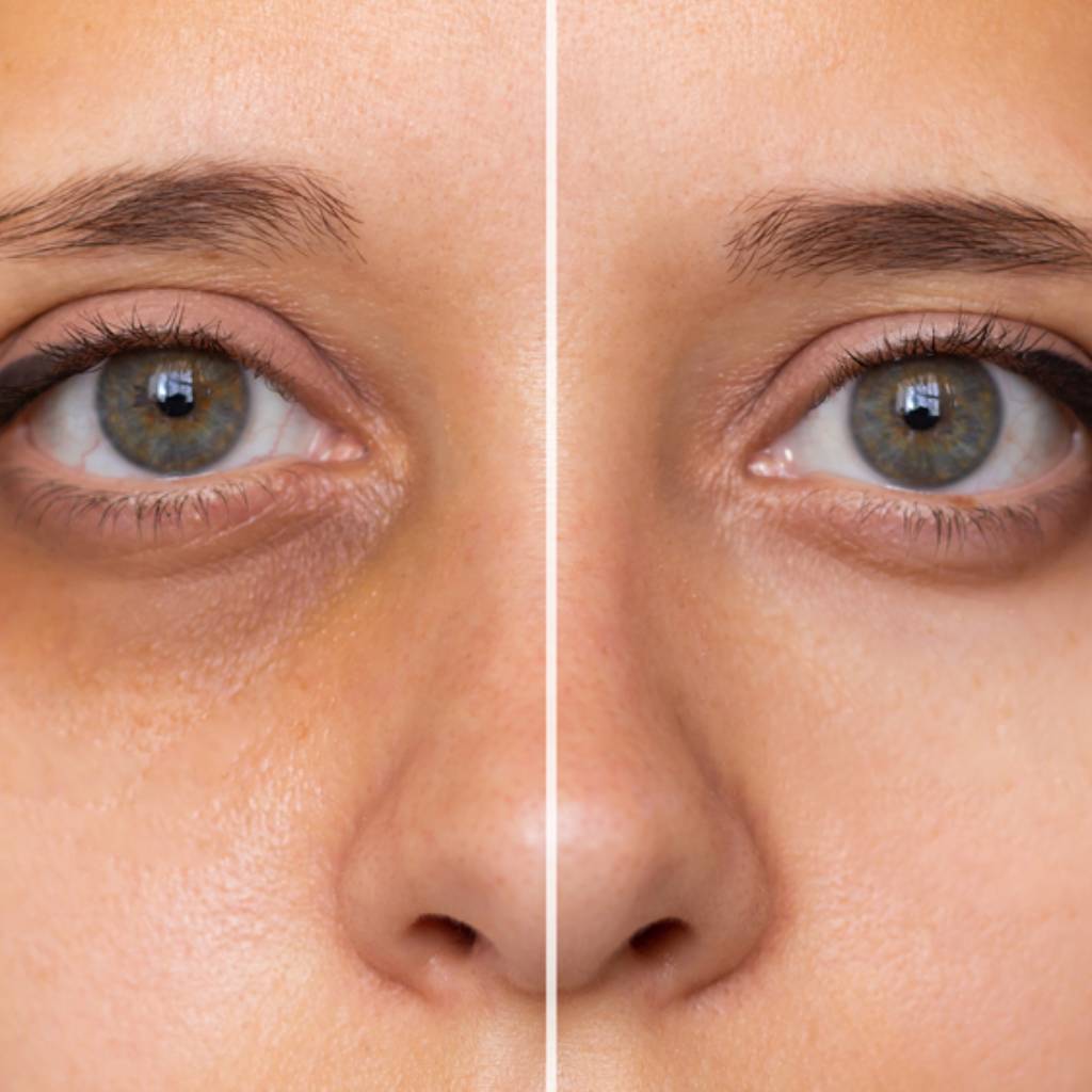 Ojeras