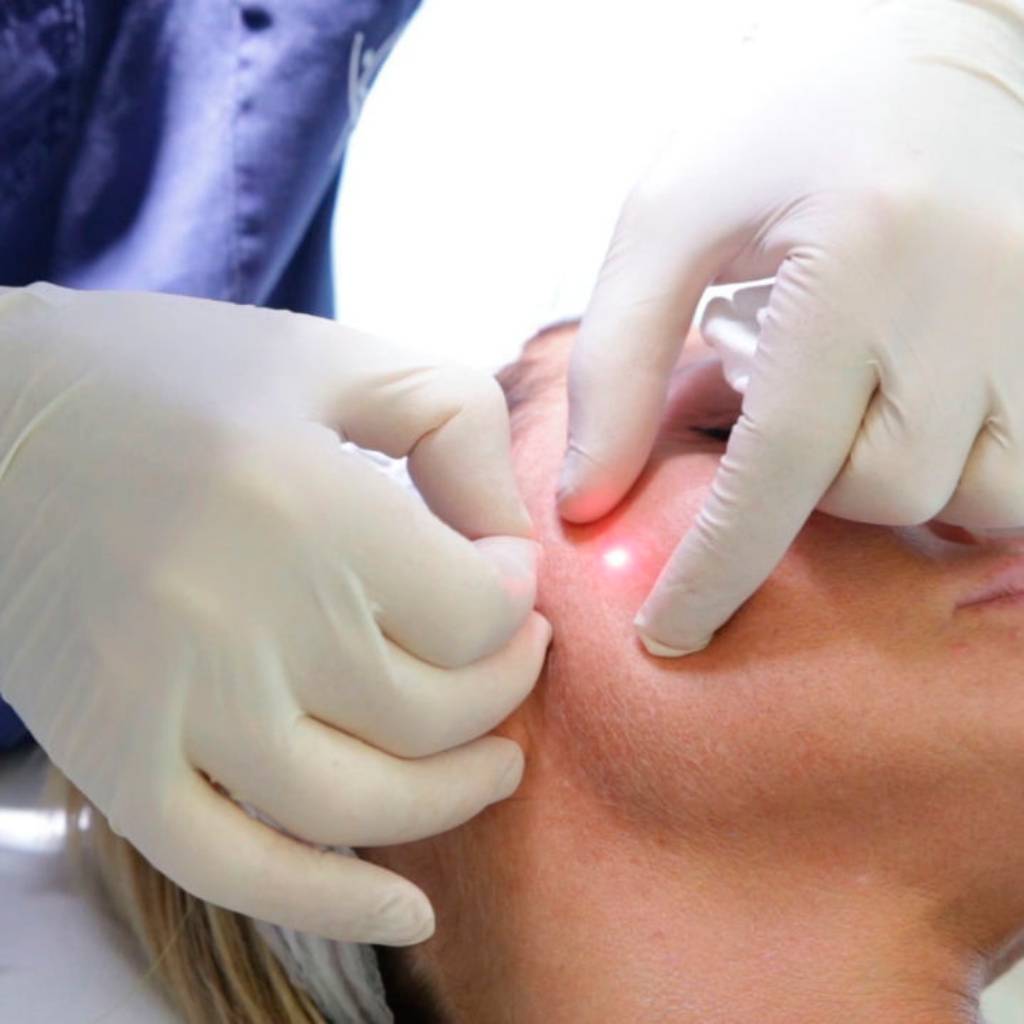 Endolift